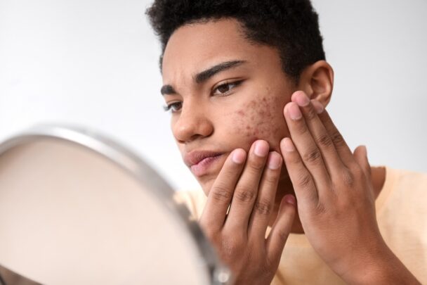 Jongen met acne op zijn wang kijkt onzeker in de spiegel.